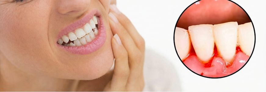 Identifying Causes, Symptoms & Care for Bleeding Gums Treatment