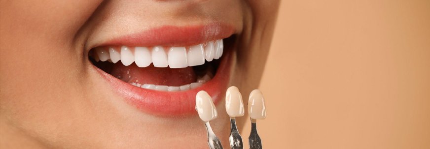 E-Max Veneers