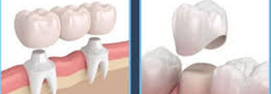 Dental Crowns and Bridges