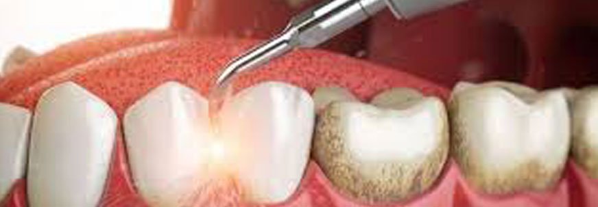 Scaling and Polishing at Al Dhabi Dental Clinic