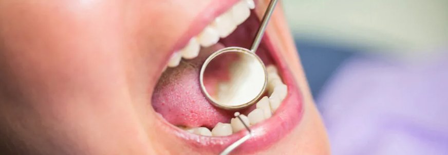 Root Canal Treatment in Musaffah at Al-Dhabi Dental Clinic