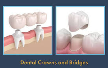 Dental Crowns and Bridges