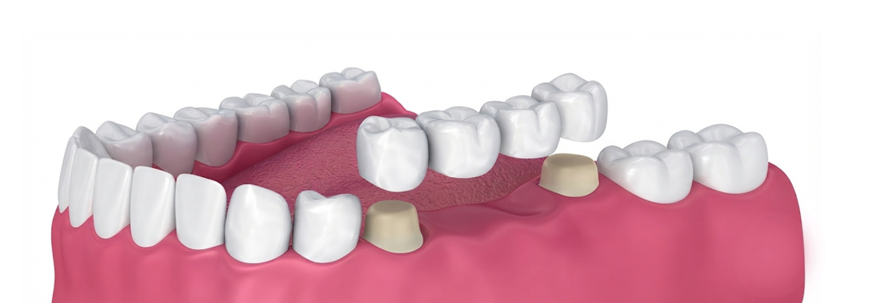Dental Restoration Treatment in Abu Dhabi